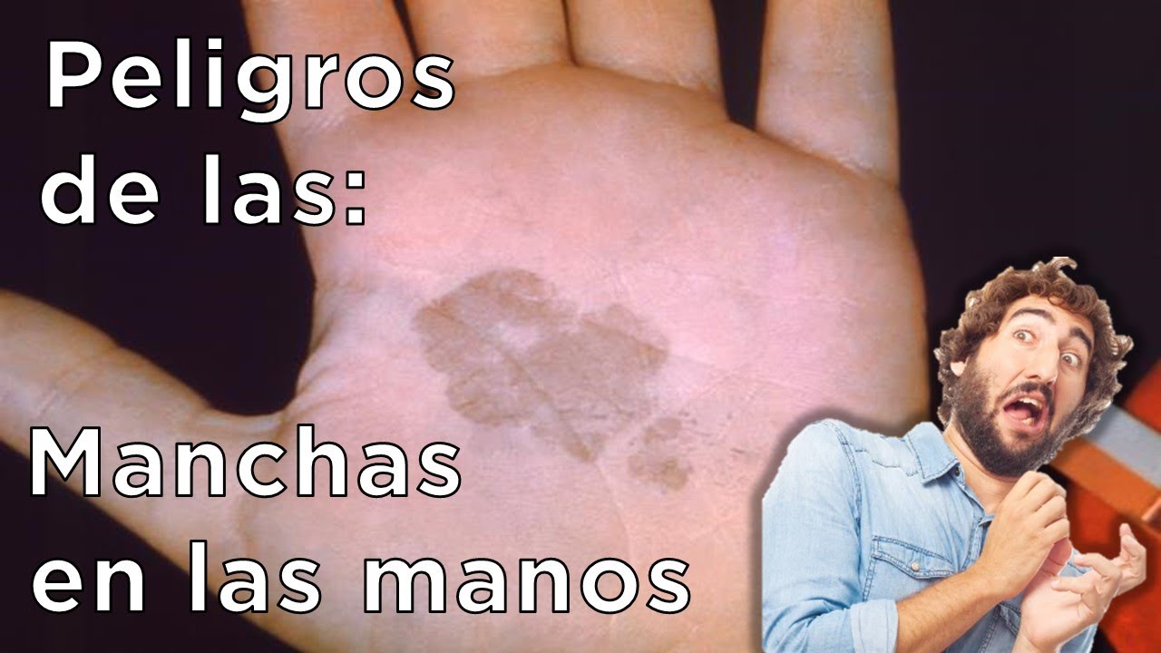 manchas en la palma de las manos