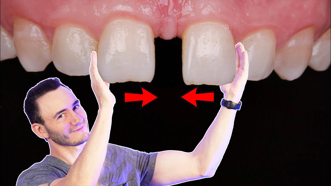 como juntar los dientes separados casero