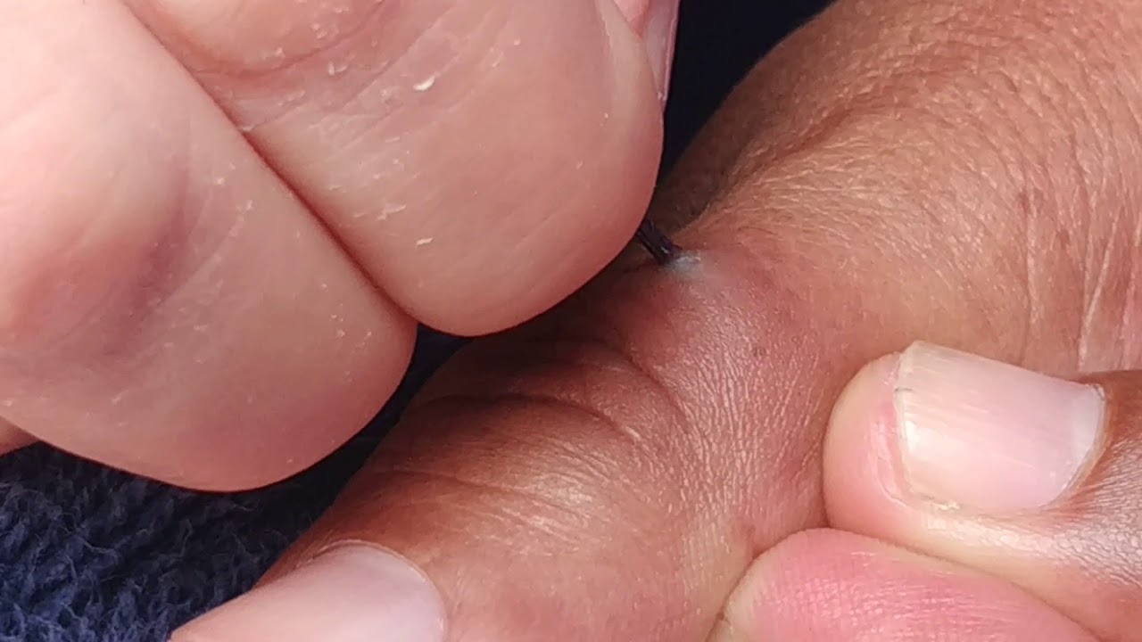 como sacar espinas de erizo